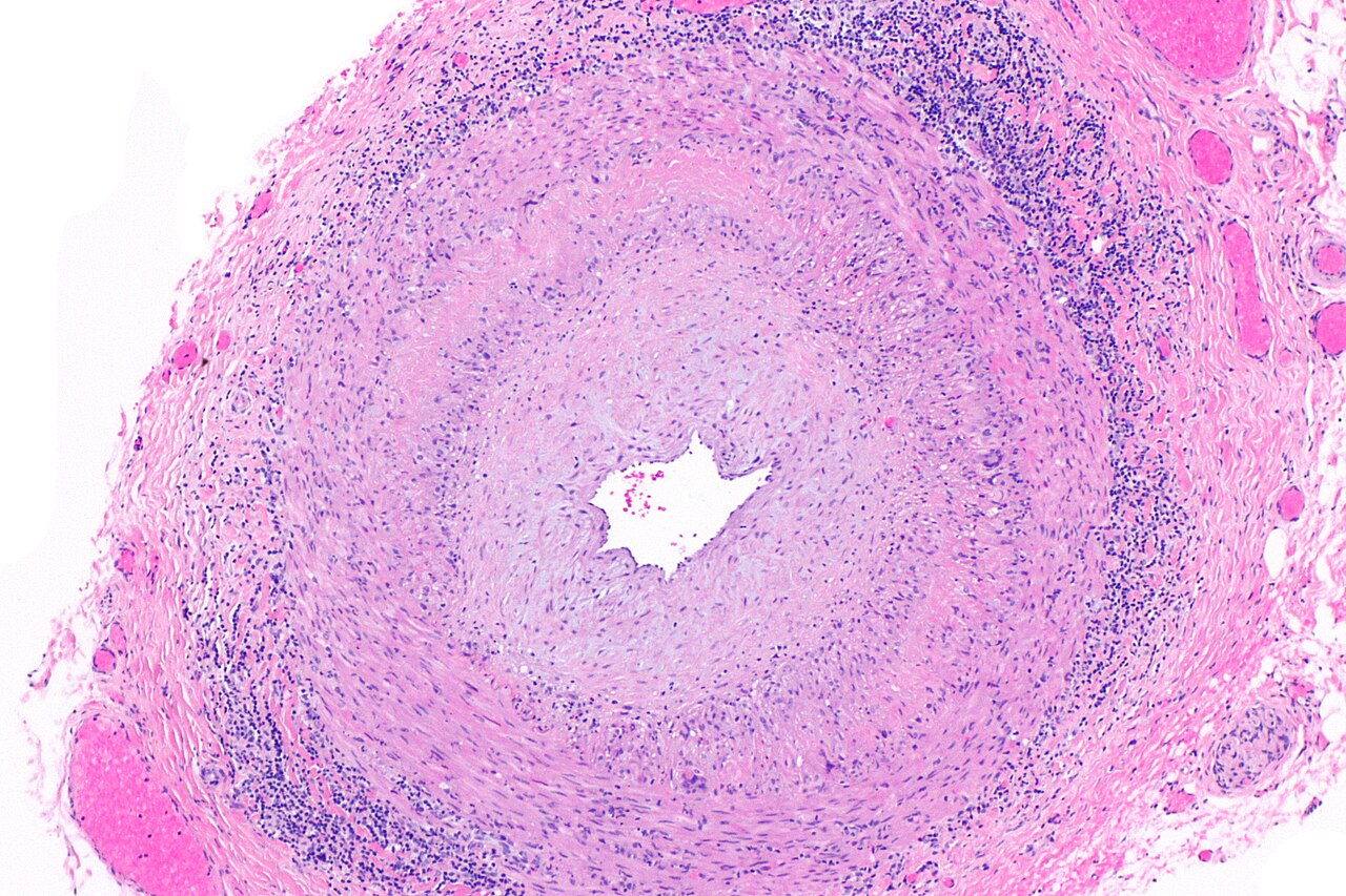 Low-magnification H and E temporal-artery section showing a narrowed lumen and a thickened inflamed arterial wall in giant cell arteritis