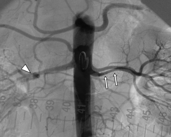Renal angiogram with multifocal beading in an accessory left renal artery marked by arrows, and a right renal artery aneurysm marked by an arrowhead