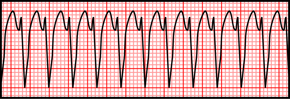 Published vector teaching illustration of monomorphic ventricular tachycardia, with repeated broad complexes