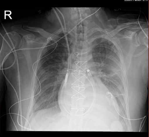 Impella RP Flex